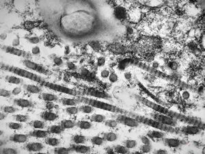 F, 45y. | necrobiosis lipoidica F, 45y. | necrobiosis lipoidica